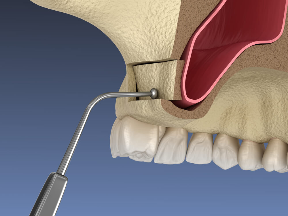 Sinus Lift Surgery