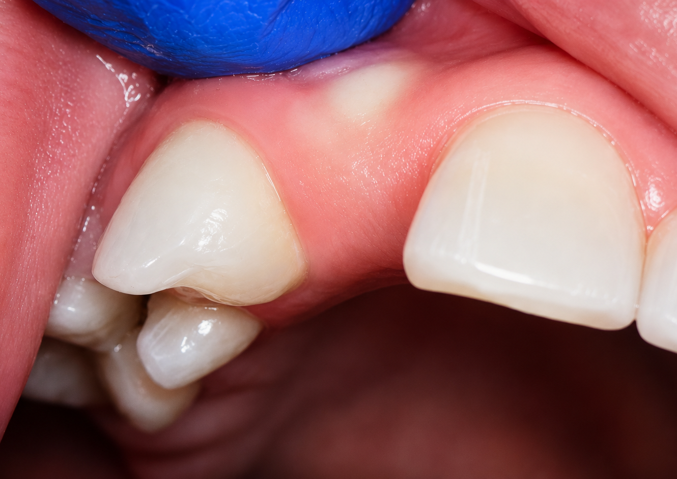 Uncovering Buried Teeth