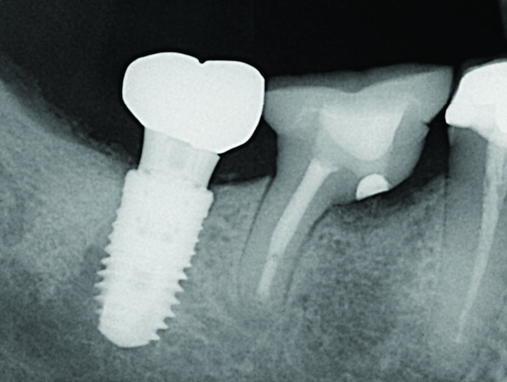 Root Resection And Retrograde Fillings